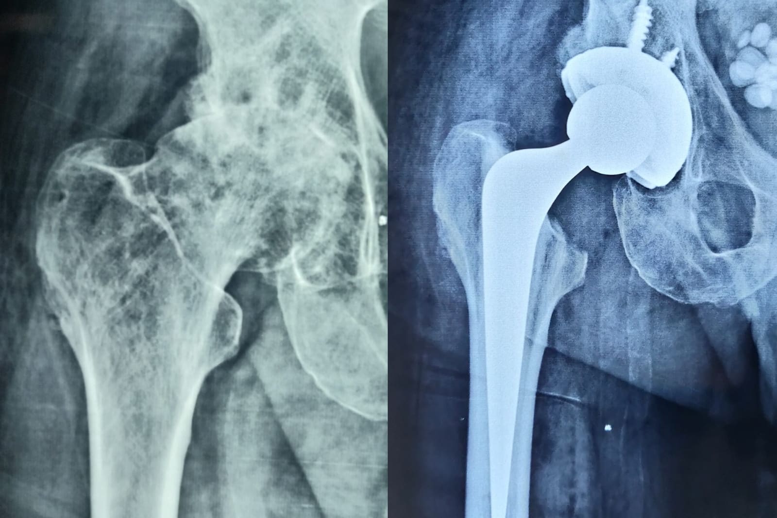 Joint Replacement (Hip & Knee)